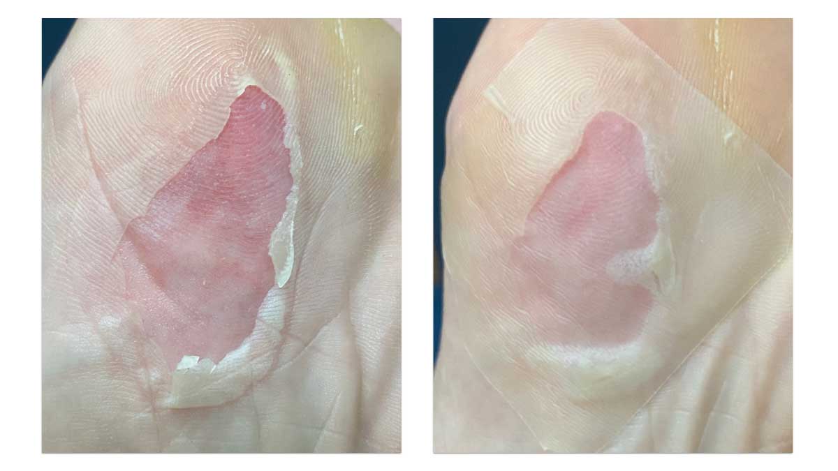 水疱膜を切除してハイドロコロイドを貼る